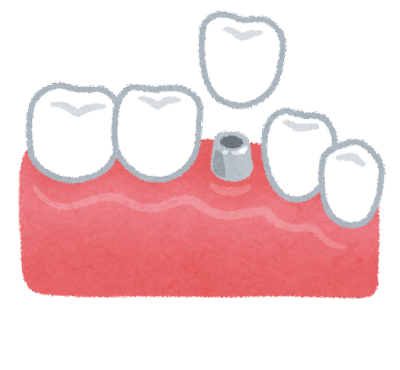 teeth_implant.png